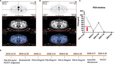 The Evolving Role of 18F-FDG PET/CT in Diagnosis and Prognosis Prediction in Progressive Prostate Cancer